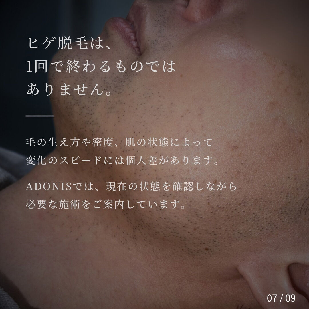 【ヒゲ脱毛｜モニター様の経過記録】