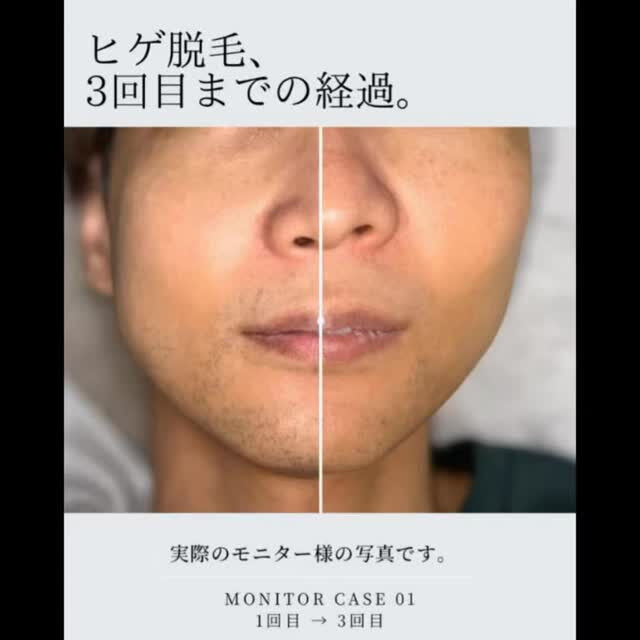 1回目から3回目までの、ヒゲ脱毛の経過
