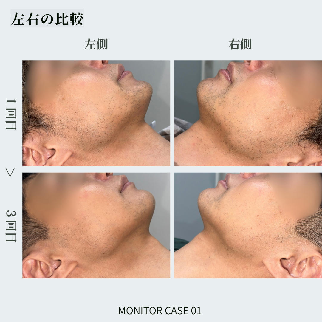 耳毛脱毛