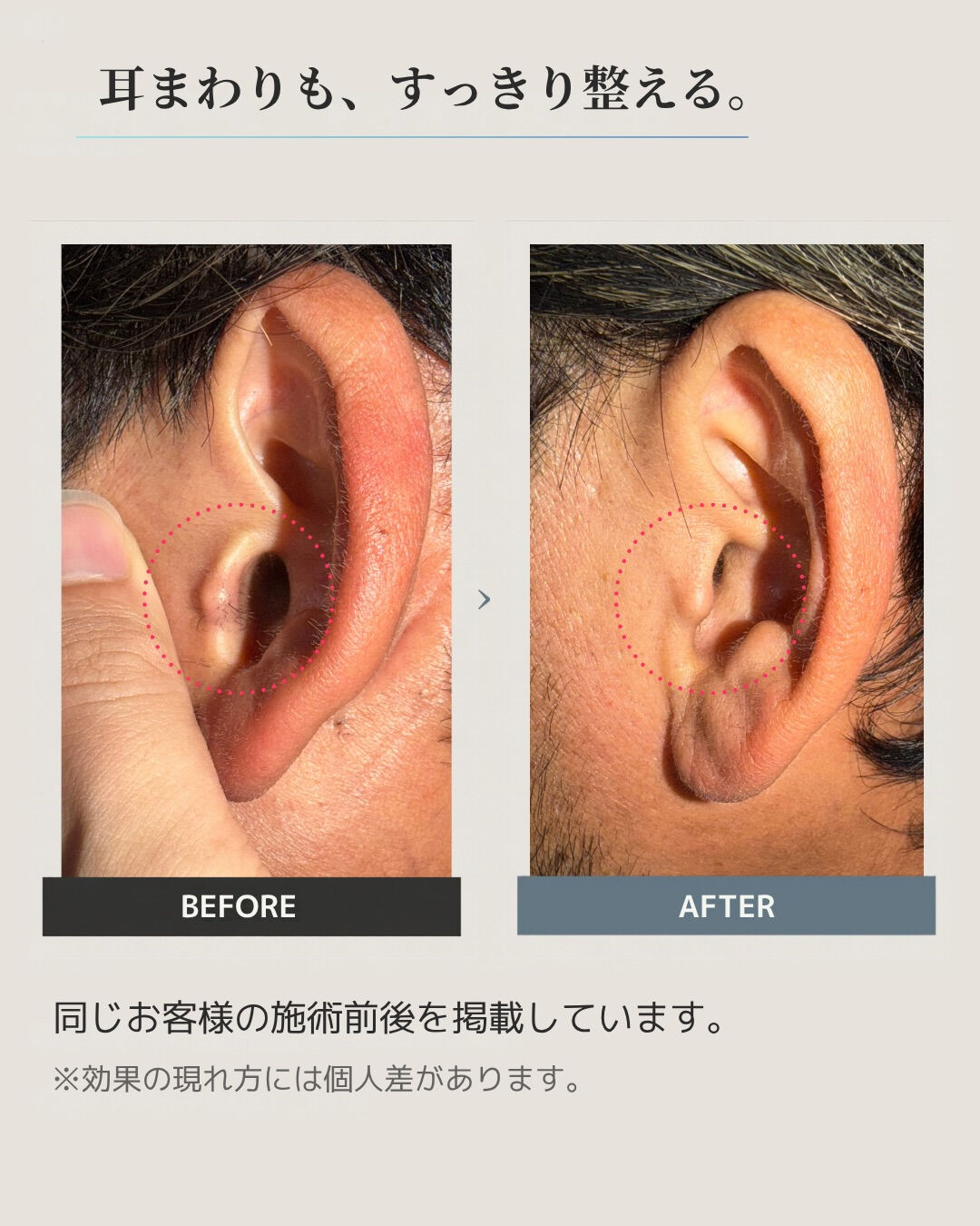 耳毛、脱毛できます