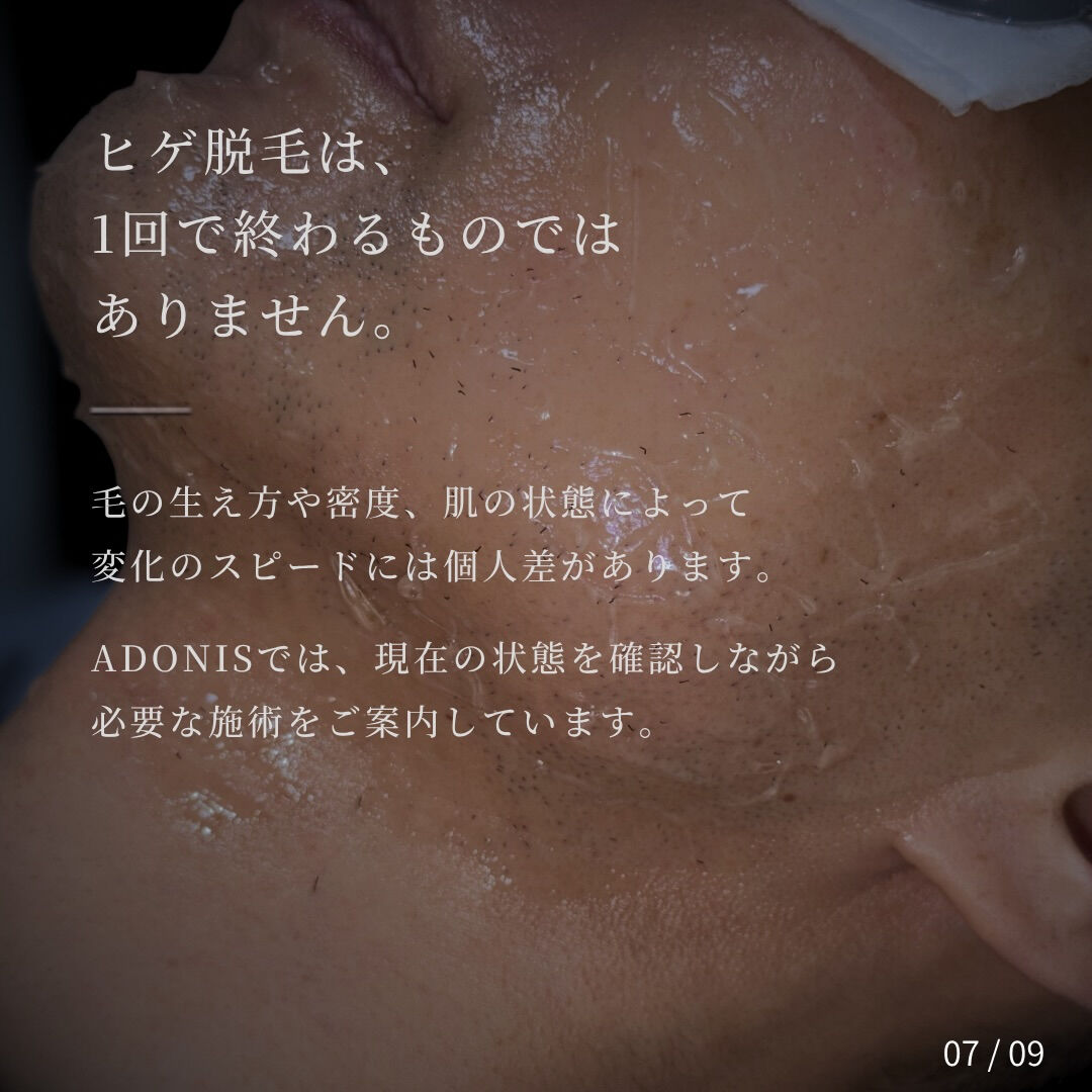 【ヒゲ脱毛｜モニター様の経過記録】